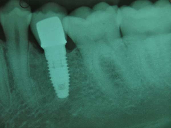 Dental restoration