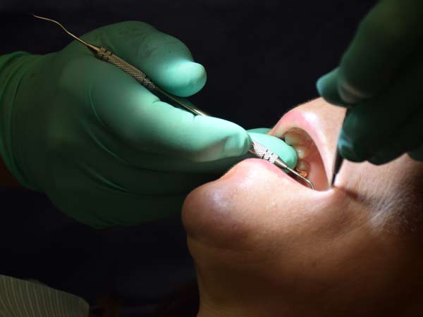 Tooth fillings